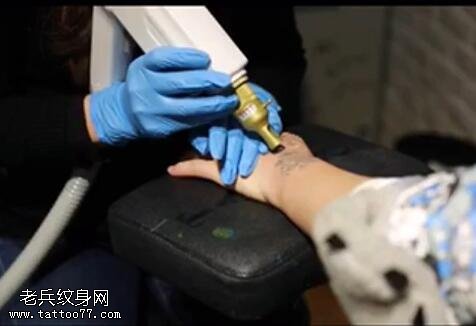 武汉最好的洗纹身店：激光洗纹身视频