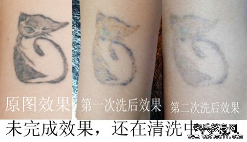 专业激光洗纹身店洗纹身真的不留疤吗??