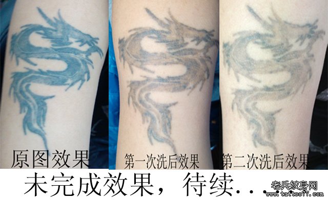大臂图腾龙黑色激光洗纹身步骤