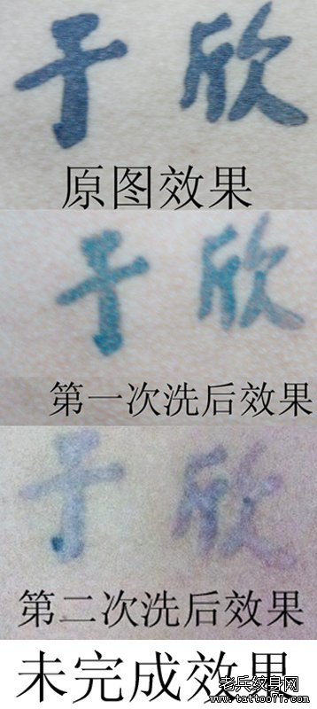 胸口黑色汉字激光洗纹身效果由武汉专业洗纹身店提供