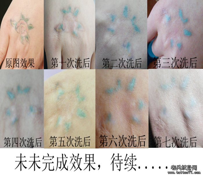 手背彩色花卉激光洗纹身案例由武汉专业洗纹身店提供