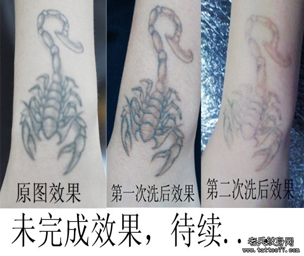 手部蝎子黑色激光特色洗纹身效果