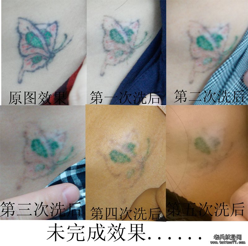 锁骨彩色蝴蝶激光洗纹身效果