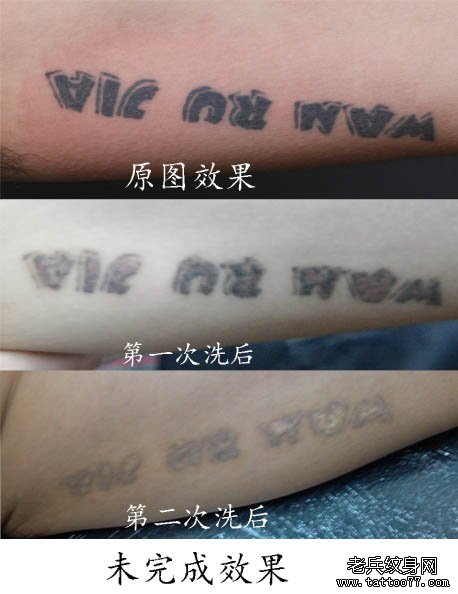 专业激光洗纹身之大臂内侧黑色字母洗纹身效果