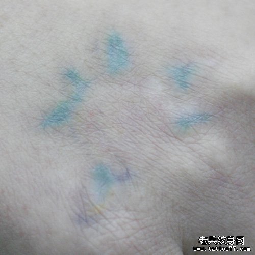 手部红色绿色激光洗纹身案例