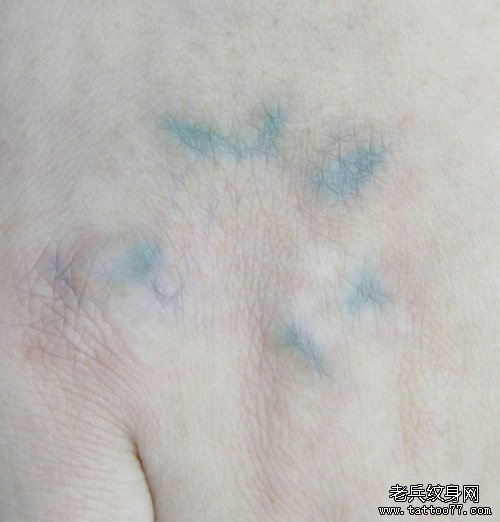 手部红色绿色激光洗纹身案例