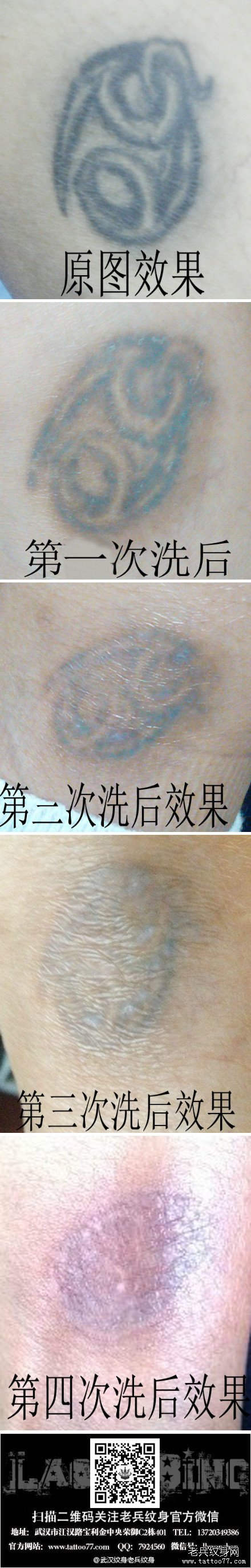 脚踝黑色星座特色激光洗纹身案例