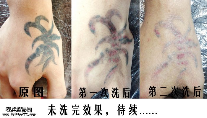 武汉专业激光洗纹身手背黑色洗纹身效果